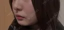 RF（高周波）たるみ治療 RIVER CLINIC（リバークリニック） DAY 6 サムネイル用