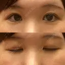 二重切開 / 眼瞼下垂（切開） / 上まぶたたるみ取り ユア美容クリニック 福岡院 DAY 26 サムネイル用