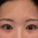 クマ治療 / 下まぶたの脂肪取り / ヒアルロン酸注入（目の下） / RF（高周波）たるみ治療 / その他（目元） ROOTS Clinic DAY 0 サムネイル用