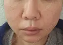 糸リフト / 脂肪吸引（顔） / ボトックス（額） EMMO FACE CLINIC 東京三田院 AFTER サムネイル用