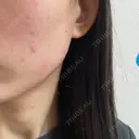 水光注射（ハリ・美肌） Rinato Beauty Clinic DAY 2 サムネイル用