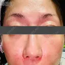 肌育注射（ジュベルックなど） / リジュラン 新宿Ladies&Gentlemen美容クリニック DAY 8 サムネイル用