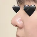 隆鼻術 / 鼻尖形成（切開） / 鼻中隔延長（切開） / 軟骨移植 / 骨切幅寄せ / 鼻翼基部形成（貴族手術） / 鼻柱下降・鼻唇角形成（猫手術） 4Dクリニック DAY 30 サムネイル用