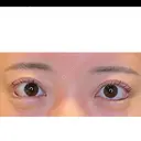 タレ目形成・グラマラスライン（埋没） LOUIS CLINIC 二子玉川院【ルイクリニック】 DAY 0 サムネイル用