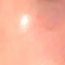 ニードルRF（ポテンツァなど） 広島プルミエクリニック DAY 17 サムネイル用