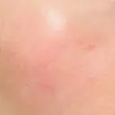 ニードルRF（ポテンツァなど） 広島プルミエクリニック AFTER サムネイル用