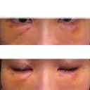脂肪注入（目の下） 大塚美容形成外科 京都院 DAY 6 サムネイル用