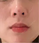 ヒアルロン酸注入（鼻） / ヒアルロン酸注入（鼻翼基部） プロジェクトユー医院 DAY 2 サムネイル用