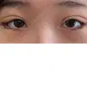 二重埋没 / 目尻切開 / タレ目形成・グラマラスライン（切開） YBC横浜美容外科 池袋院 DAY 5 サムネイル用