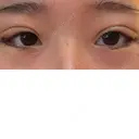 二重埋没 / 目尻切開 / タレ目形成・グラマラスライン（切開） YBC横浜美容外科 池袋院 DAY 6 サムネイル用