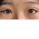 二重埋没 / 目尻切開 / タレ目形成・グラマラスライン（切開） YBC横浜美容外科 池袋院 DAY 7 サムネイル用