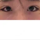 二重埋没 / 目尻切開 / タレ目形成・グラマラスライン（切開） YBC横浜美容外科 池袋院 DAY 8 サムネイル用