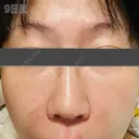 肌育注射（ジュベルックなど） / リジュラン 新宿Ladies&Gentlemen美容クリニック DAY 9 サムネイル用