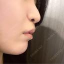 その他（鼻） / 人中短縮 / 鼻柱下降・鼻唇角形成（猫手術） Otus Clinic 【オータスクリニック】 DAY 23 サムネイル用