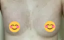 豊胸（脂肪注入） 銀座マイアミ美容外科 DAY 38 サムネイル用