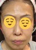 ピコレーザートーニング（美白・肝斑） / フラクショナルレーザー（毛穴・ニキビ跡） Mavie Beauty Clinic （マヴィービューティークリニック） AFTER サムネイル用