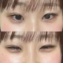 ヒアルロン酸注入（涙袋） AYANAフィラーズクリニック 武蔵小杉院 DAY 1 サムネイル用