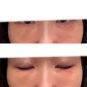 脂肪注入（目の下） 大塚美容形成外科 京都院 DAY 8 サムネイル用