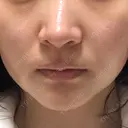 RF（高周波）たるみ治療 あいちビューティークリニック DAY 30 サムネイル用