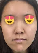 医療脱毛（顔） 日本美容・医療クリニック 六本木院 DAY 14 サムネイル用