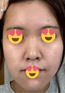 医療脱毛（顔） 日本美容・医療クリニック 六本木院 AFTER サムネイル用