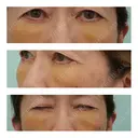 下まぶたたるみ取り WOM CLINIC GINZA （ワム クリニック ギンザ） DAY 6 サムネイル用