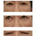 下まぶたたるみ取り WOM CLINIC GINZA （ワム クリニック ギンザ） AFTER サムネイル用