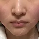 RF（高周波）たるみ治療 あいちビューティークリニック AFTER サムネイル用