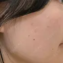 光治療（フォトフェイシャルなど） LUNA BEAUTY CLINIC 池袋駅前院 DAY 4 サムネイル用