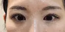 クマ治療 / 下まぶたの脂肪取り / ヒアルロン酸注入（目の下） / RF（高周波）たるみ治療 / その他（目元） ROOTS Clinic DAY 7 サムネイル用