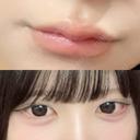 ヒアルロン酸注入（涙袋） / ヒアルロン酸注入（唇） HAAB×DREAM BEAUTY CLINIC 大阪梅田院 DAY 1 サムネイル用