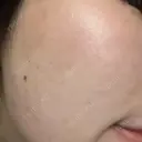 光治療（フォトフェイシャルなど） LUNA BEAUTY CLINIC 池袋駅前院 AFTER サムネイル用