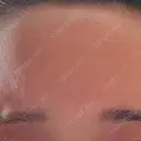 ボトックス（眉間） / ボトックス（額） / その他（鼻） TCB東京中央美容外科 盛岡院 DAY 2 サムネイル用