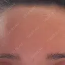 ボトックス（眉間） / ボトックス（額） / その他（鼻） TCB東京中央美容外科 盛岡院 AFTER サムネイル用