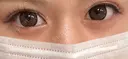 二重切開 オーキッド美容クリニック東京御徒町 DAY 235 サムネイル用