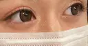 二重切開 オーキッド美容クリニック東京御徒町 DAY 235 サムネイル用