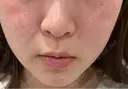 輪郭修正 ビューティー和心クリニック 浅草院 DAY 0 サムネイル用