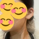 ボトックス（エラ・小顔） / ボトックス（額） TCB東京中央美容外科 長野院 DAY 4 サムネイル用