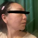 糸リフト / クマ治療 / 下まぶたの脂肪取り / 脂肪注入（肌） / こめかみ形成 / 脂肪注入（目の下） / ボトックス（あご） / ボトックス（首） 東京シンデレラ美容外科 池袋院 DAY 1 サムネイル用