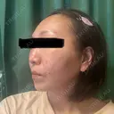 糸リフト / クマ治療 / 下まぶたの脂肪取り / 脂肪注入（肌） / こめかみ形成 / 脂肪注入（目の下） / ボトックス（あご） / ボトックス（首） 東京シンデレラ美容外科 池袋院 DAY 1 サムネイル用