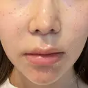 人中短縮 聖心美容クリニック 六本木院 DAY 50 サムネイル用