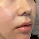 人中短縮 聖心美容クリニック 六本木院 DAY 50 サムネイル用