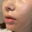 人中短縮 聖心美容クリニック 六本木院 DAY 50 サムネイル用