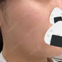 ルメッカ Belle Via Skin Clinic DAY 18 サムネイル用