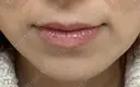 その他（輪郭） ルラ美容クリニック 広島院 AFTER サムネイル用