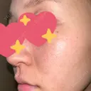 ニードルRF（ポテンツァなど） / ポテンツァ BAO CLINIC 神戸院 DAY 5 サムネイル用