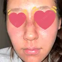 ニードルRF（ポテンツァなど） / ポテンツァ BAO CLINIC 神戸院 DAY 0 サムネイル用