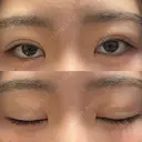 二重埋没 WOM CLINIC GINZA （ワム クリニック ギンザ） DAY 6 サムネイル用