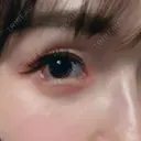 糸リフト / 目尻切開 / タレ目形成・グラマラスライン（切開） / ボトックス（あご） / ヒアルロン酸注入（あご） / ヒアルロン酸注入（鼻翼基部） Tokyo Tensei Clinic 新宿院 DAY 13 サムネイル用