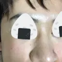 美容点滴・美容注射（美肌） / 美肌レーザー / フラクショナルレーザー（毛穴・ニキビ跡） 飯田橋駅前さくら坂クリニック DAY 5 サムネイル用